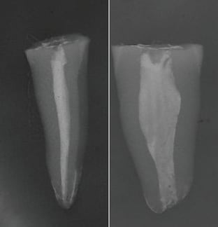 Fig.1 À esquerda radiografia de dente humano extraído, no sentido mesio-distal (mesma visualização obtida em radiografias intrabucais). À direita o mesmo dente em radiografia vestíbulo-lingual.