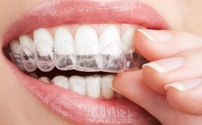 tooth-whitening-tray